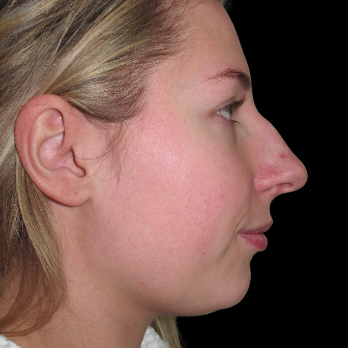 rhinoplasty-before